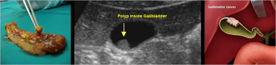 Πολύποδες στη Χολή: Μπορεί να είναι κι Επικίνδυνοι αν δε Χειρουργηθούν