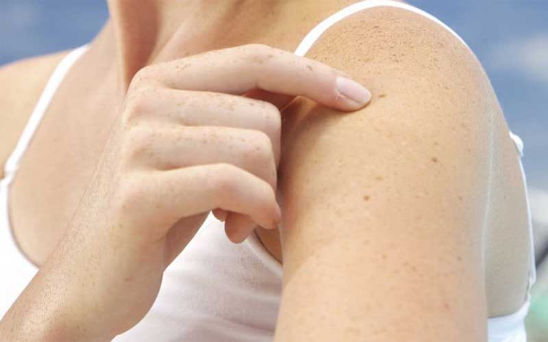 μαυρες κηλιδες