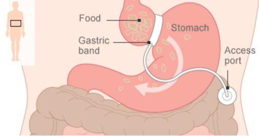 Αδυνάτισμα με Βαριατρική: Πραγματοποιεί όσα υπόσχεται;